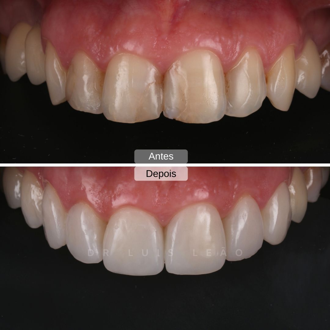 Dr. Luís Leão – Facetas Dentárias Dr. Luís Leão - Facetas Dentárias