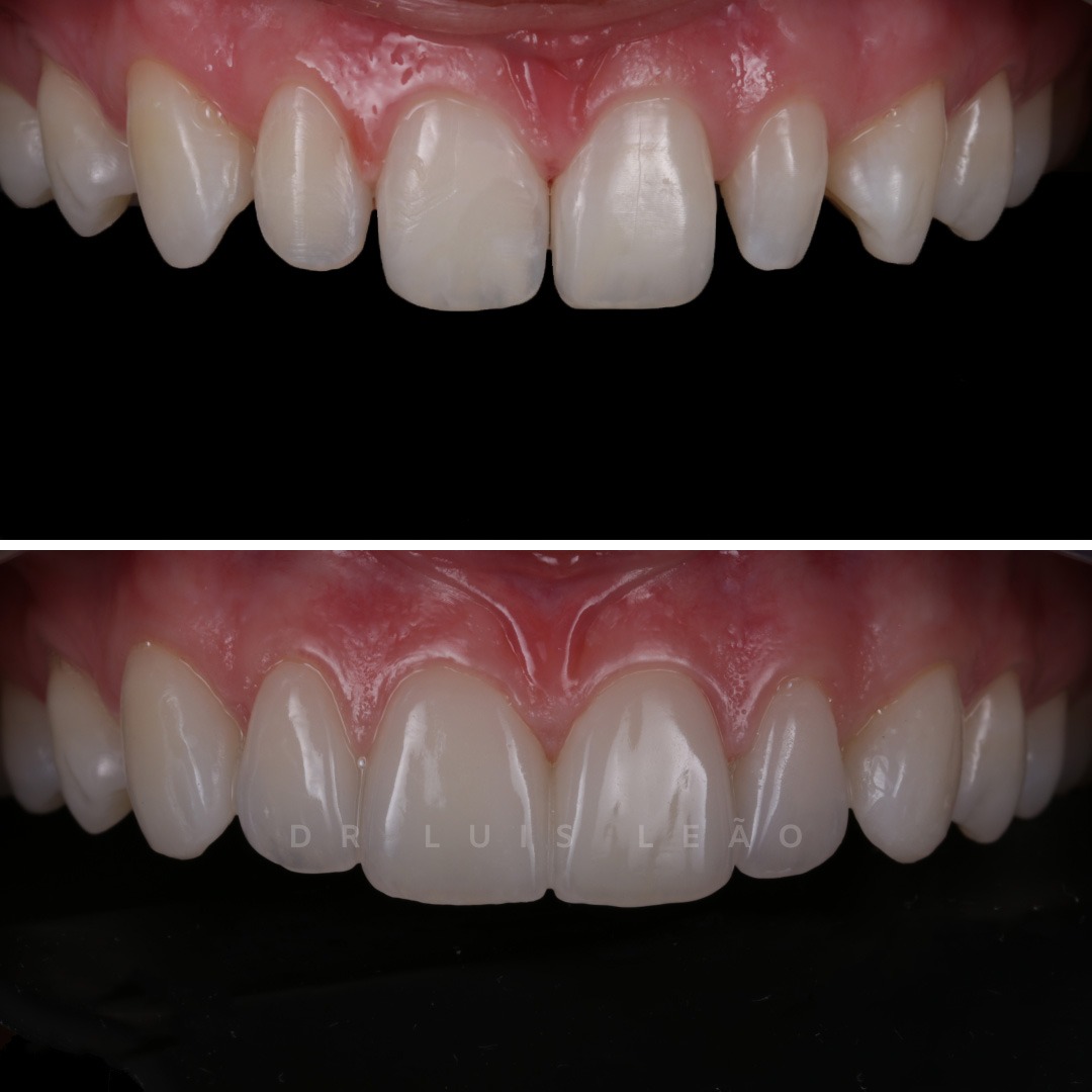 intraoral-facetas-17-1 facetas caso 17