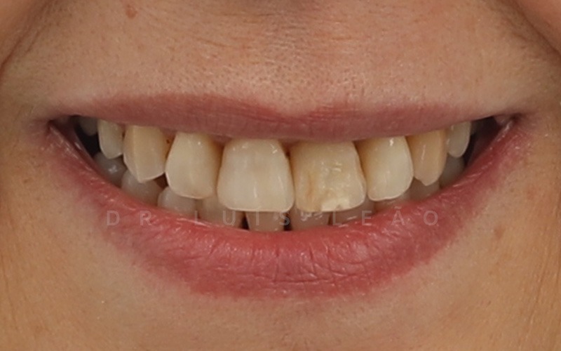 antes facetas dentárias