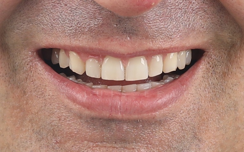 antes facetas dentárias