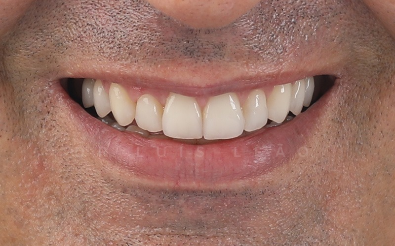 depois facetas dentárias