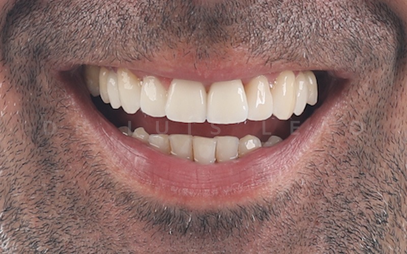 depois facetas dentárias