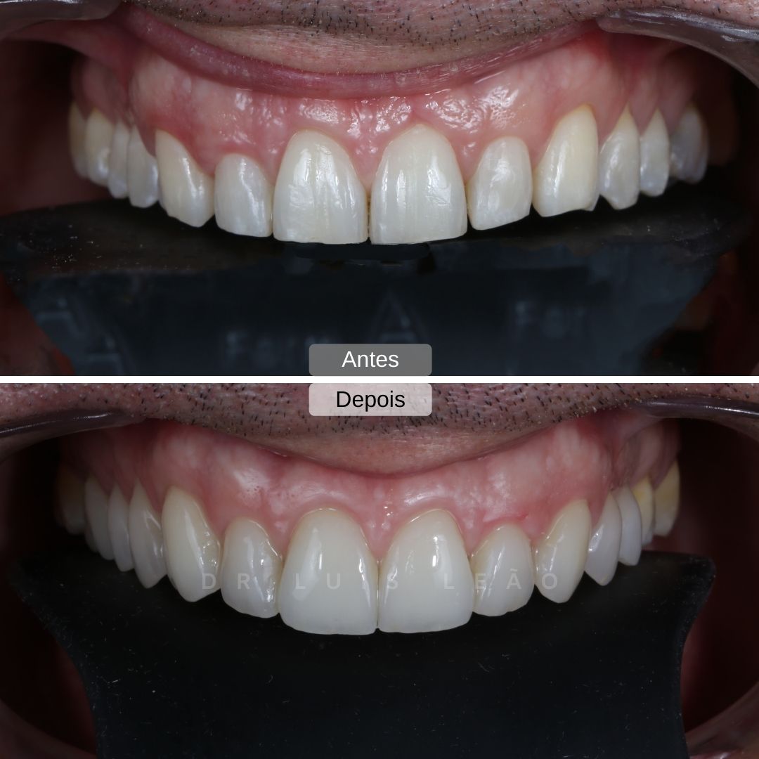 intraorais-3 facetas dentárias