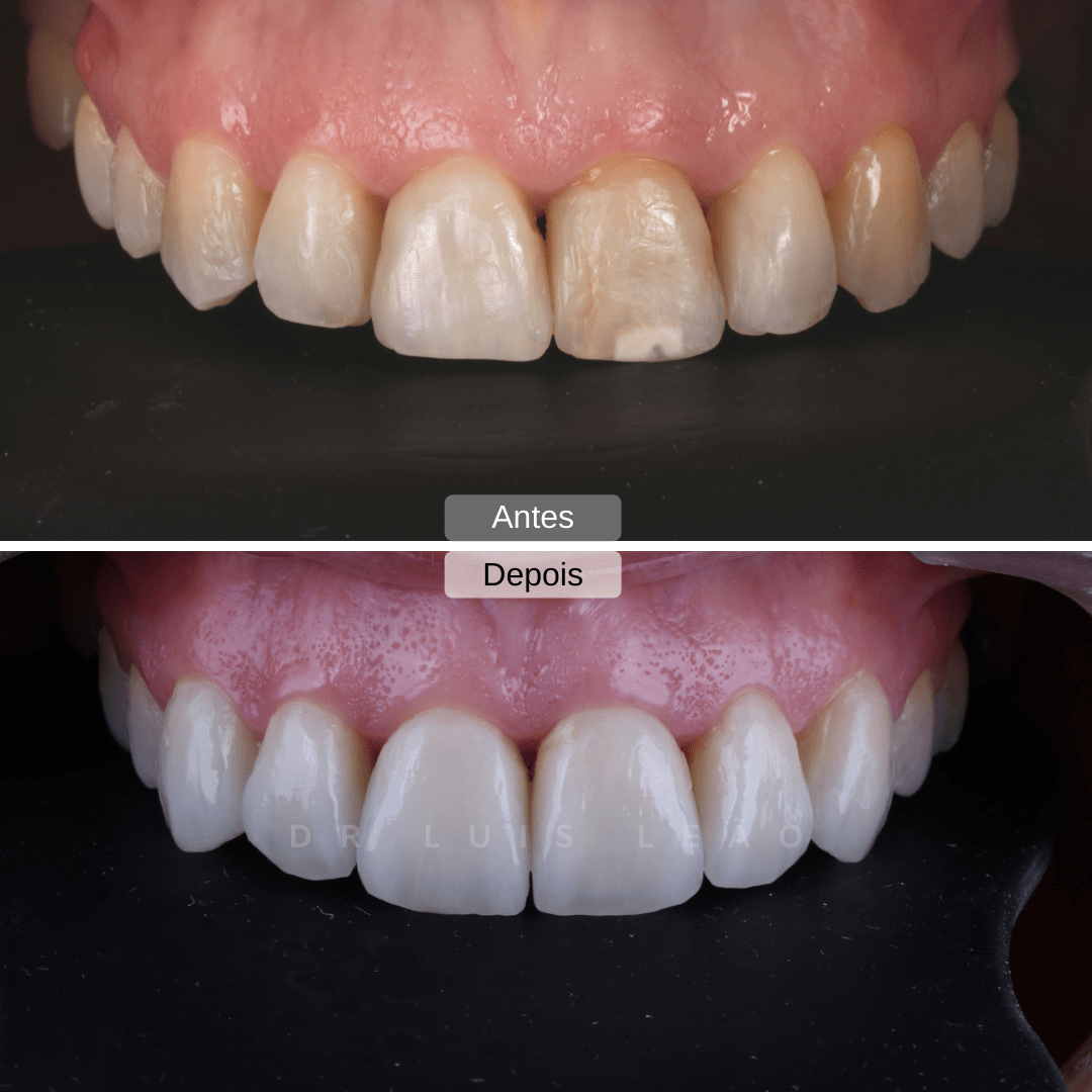 intraoral facetas dentárias
