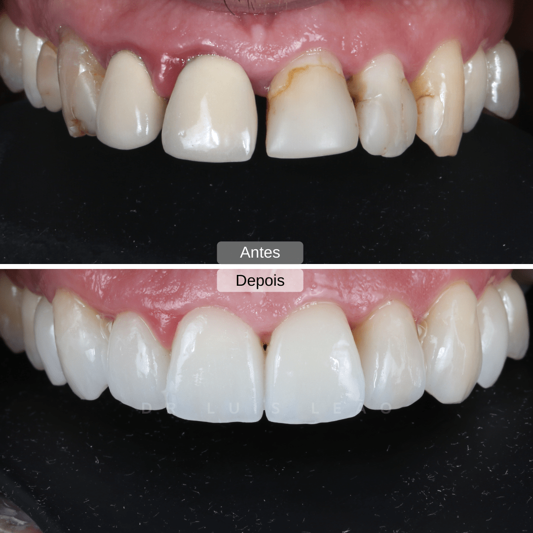 intraoral facetas dentárias